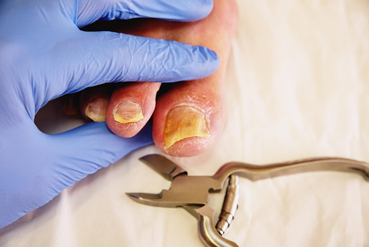 Tretman uraslog nokta